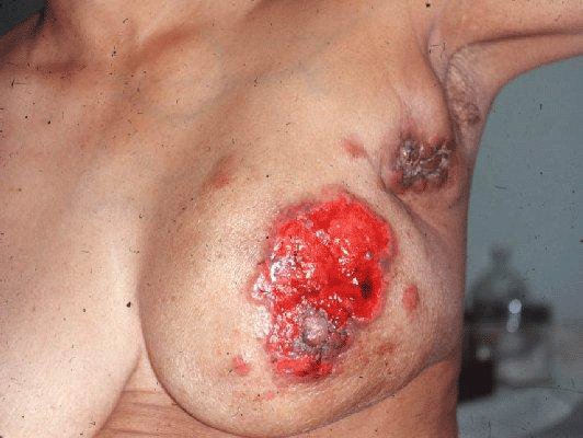 Bleeding boob.png