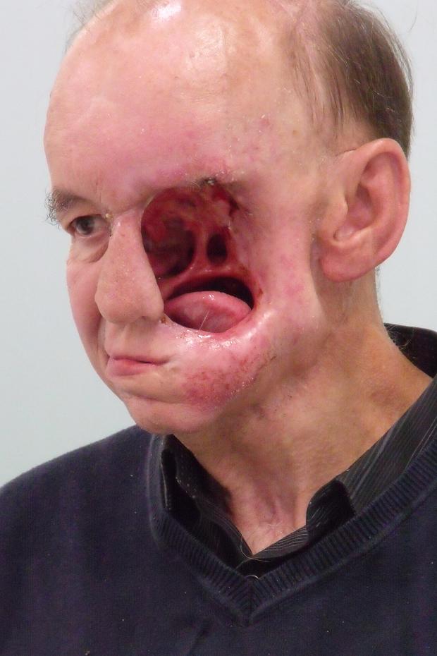 Relax, it's only a pimple...