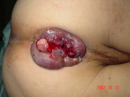 Greg's hemorrhoid-ridden anus after years of abuse by sitting on his ass all day on the Internet.